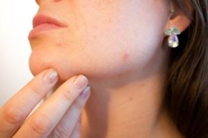 acne remedies